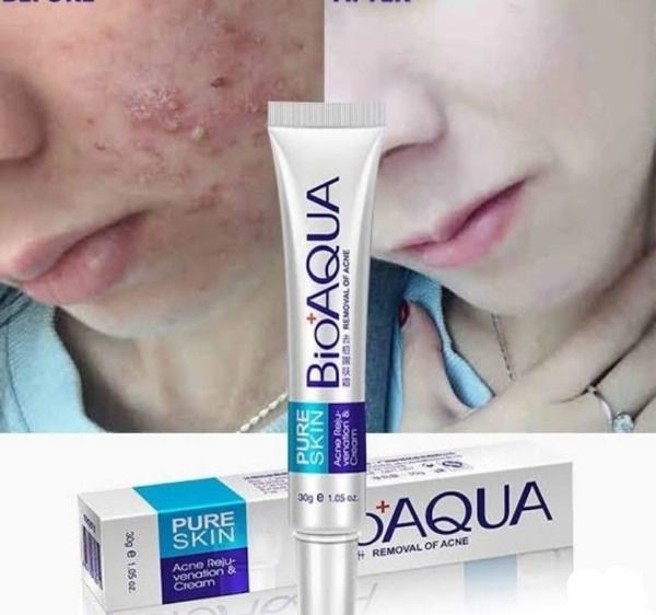 CREMA ANTI-ACNÉ Y ESPINILLAS BIOAQUA