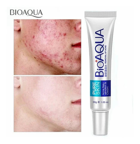 CREMA ANTI-ACNÉ Y ESPINILLAS BIOAQUA