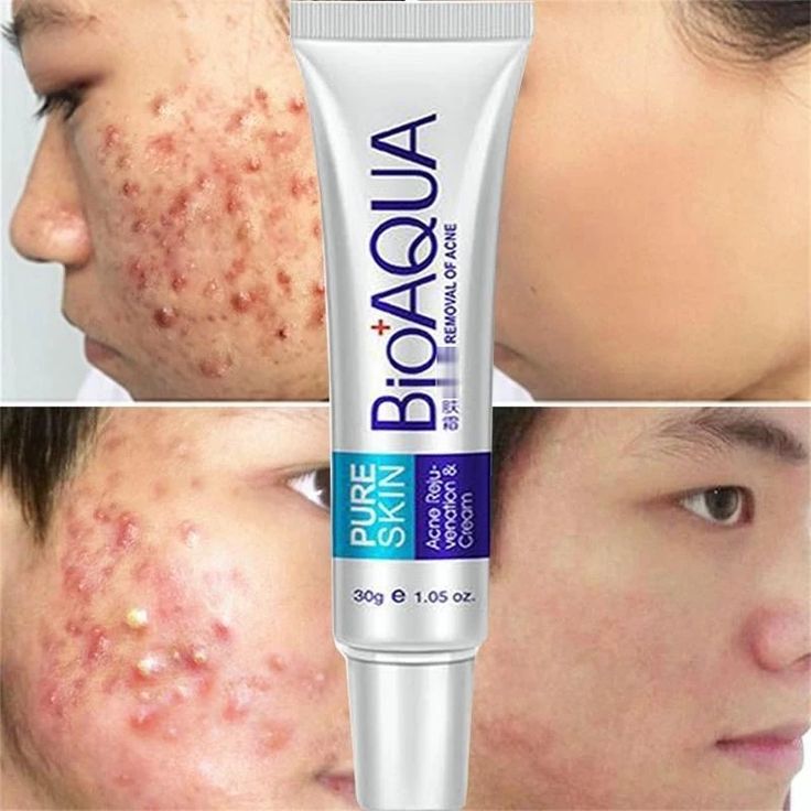 CREMA ANTI-ACNÉ Y ESPINILLAS BIOAQUA